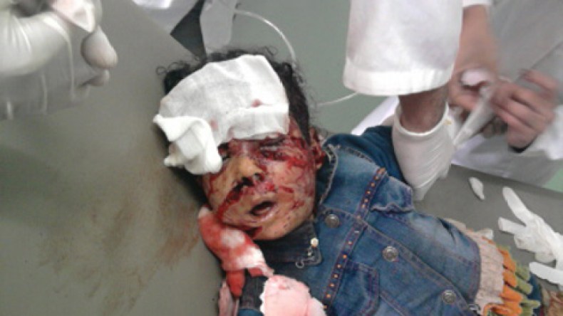 كلب مسعور يلتهم وجه الطفلة أماني عند خروجها من المدرسة في ميلة