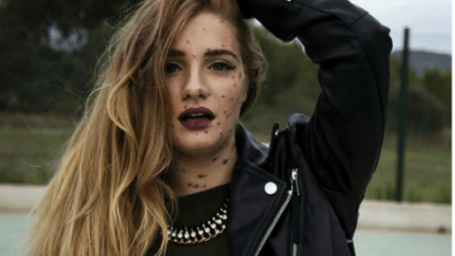 ماريا إيزابيل.. تحدت مرضها الغريب وحققت الشهرة!