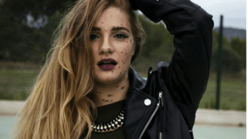 ماريا إيزابيل.. تحدت مرضها الغريب وحققت الشهرة!