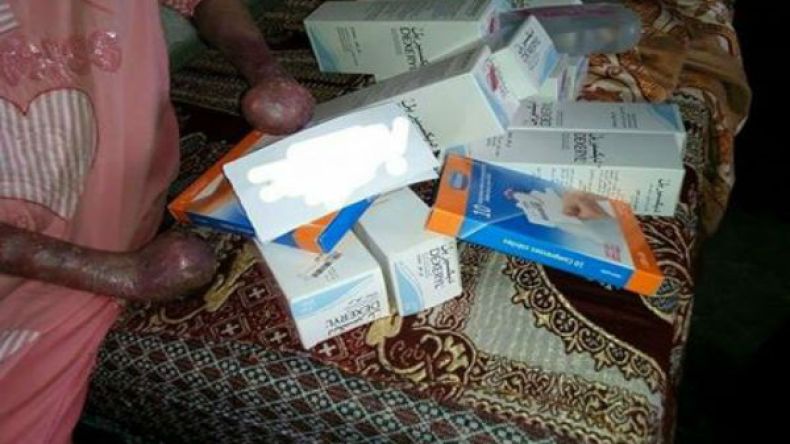 سعيدة وأمال ولدتا بمرض جلدي غريب شوه جسديهما