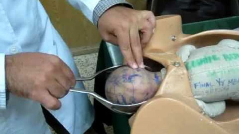 “الفورسابس” كابوس يدفع الحوامل لاختيار العمليات القيصرية!