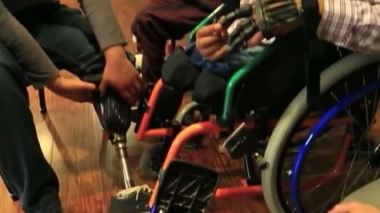 يد متحركة لفتى سوري بترت أصابعه خلال الحرب