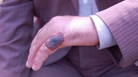 الجمرة الخبيثة تقتل شخصاً وتدخل 10 آخرين إلى المستشفى شرق روسيا