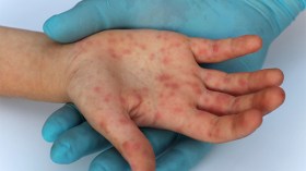 الاشتباه في 5 حالات لداء “البوحمرون” في المسيلة