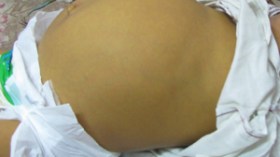 أطفال‭ ‬من‭ ‬عائلة‭ ‬فقيرة‭ ‬يموتون‭ ‬بعد‭ ‬انتفاخ‭ ‬غريب‭ ‬في‭ ‬بطونهم