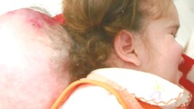 دعاء تعيش بورم في رأسها يضاهي وزنها منذ 3 سنوات