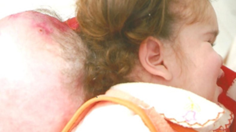 دعاء تعيش بورم في رأسها يضاهي وزنها منذ 3 سنوات