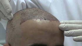 جزائريون يطيرون إلى تركيا لزرع الشعر بـ20 مليونا