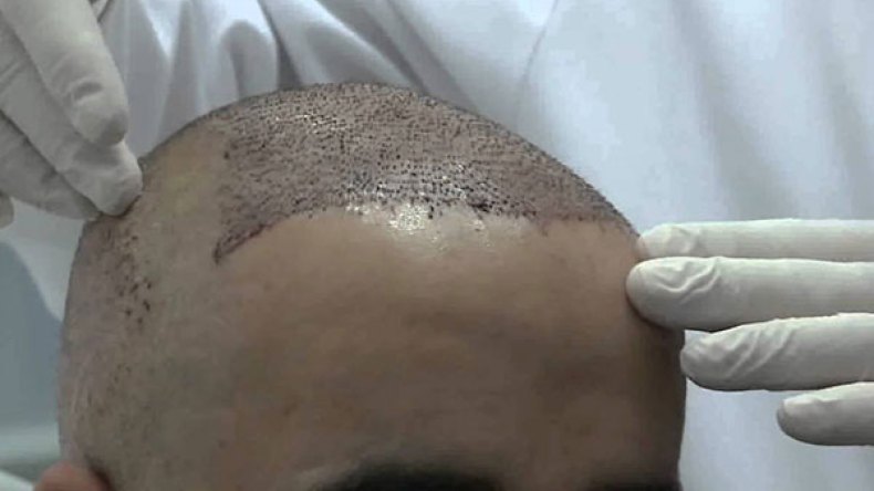 جزائريون يطيرون إلى تركيا لزرع الشعر بـ20 مليونا