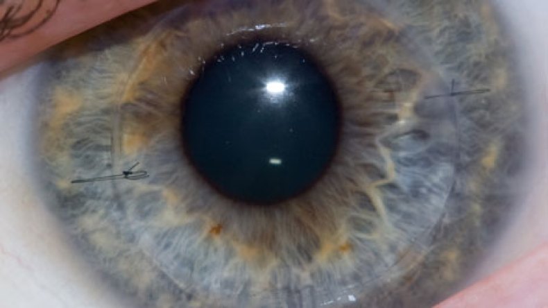 استئناف عمليات زرع القرنية بعد توقف دام ثلاث سنوات