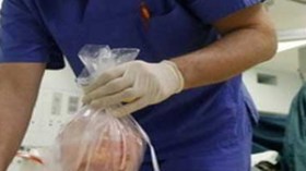 المتاجرة بالأعضاء البشرية وغياب الحماية القانونية يرهن تطور زراعتها