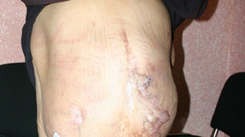 ورم يزن 5 كغ يلازم فاطمة التي تناشد نقلها إلى الخارج