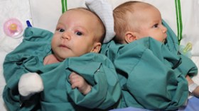 التوأم السيامي الجزائري خضعا لعملية فصل ناجحة بالسعودية