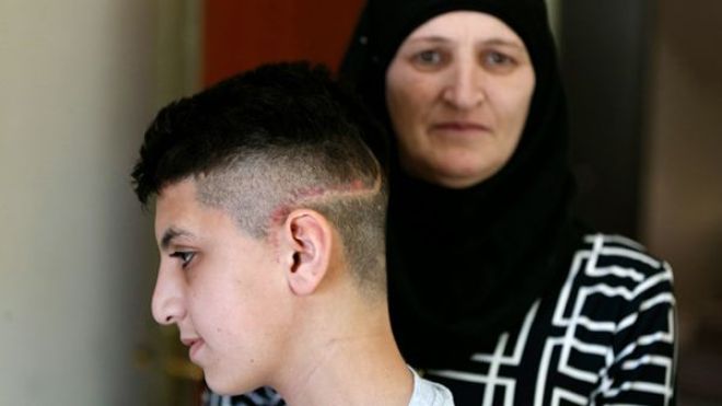 فلسطينيون مصابون بالرصاص الإسفنجي يعانون من ندوب غير قابلة للشفاء