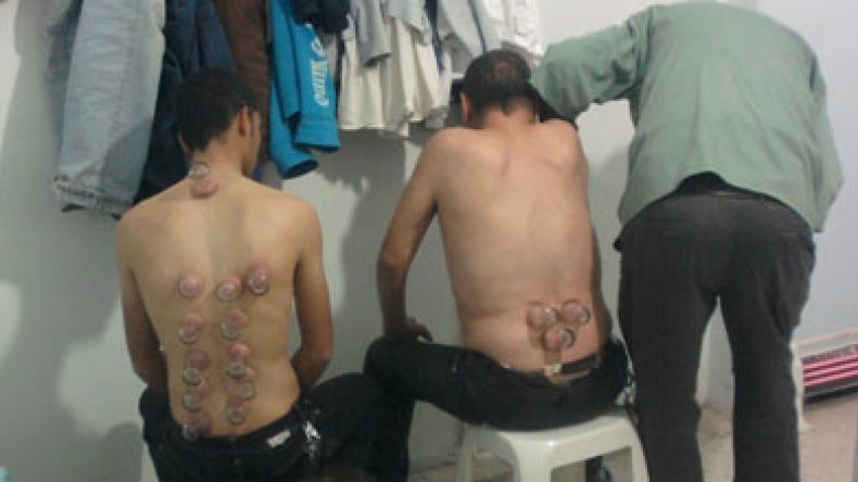 عيادات الحجامة..ثورة على الطب والأطباء