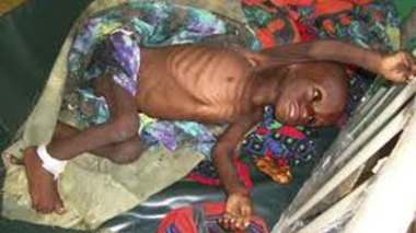 Éthiopie: la malnutrition ravage un camp de réfugiés somaliens