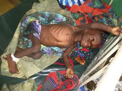 Éthiopie: la malnutrition ravage un camp de réfugiés somaliens