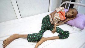 التايمز: ملايين يتضورون جوعاً في حرب اليمن المنسية