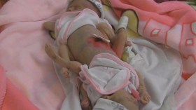 رضيعتان ملتصقتان بميلة في حاجة إلى عملية جراحية لفصلهما