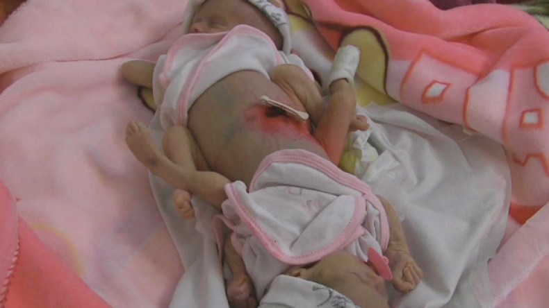 رضيعتان ملتصقتان بميلة في حاجة إلى عملية جراحية لفصلهما