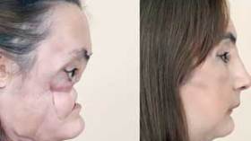 صاحبة الوجه المزروع: نجاح عملية التجميل دفعني لتطليق زوجي الغيور