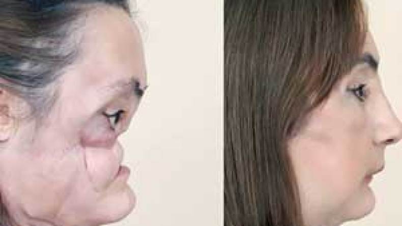 صاحبة الوجه المزروع: نجاح عملية التجميل دفعني لتطليق زوجي الغيور