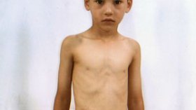 عبد الرحمن يموت في صمت ويعيش ببطن مفتوحة منذ سنتين