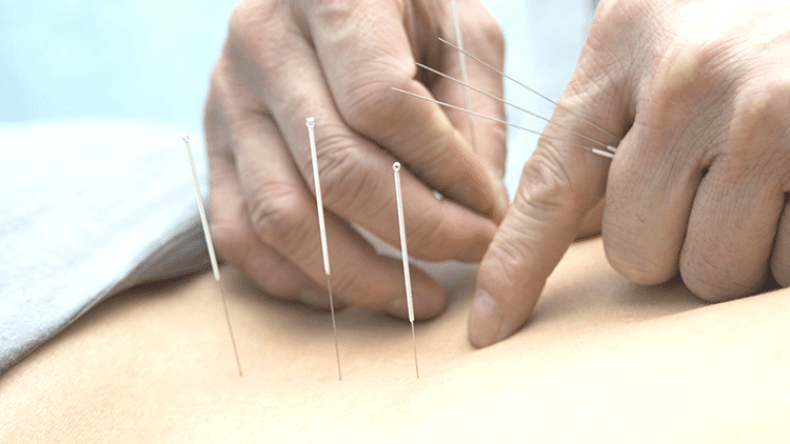 “ورشات” طبية لنحت الأجسام بالإبر الصينية