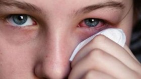 40 بالمائة من مرضى العيون يشتكون الحساسية