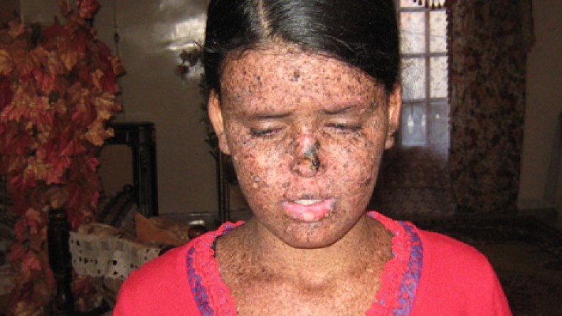 مرض “أطفال القمر” يقتل سلمى ويهدِّد حياة أمينة