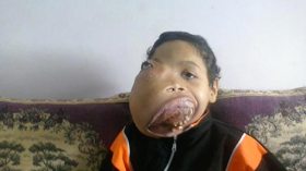 ثري سعودي يتكفل بعلاج أمين الذي يعاني من تشوه بوجهه