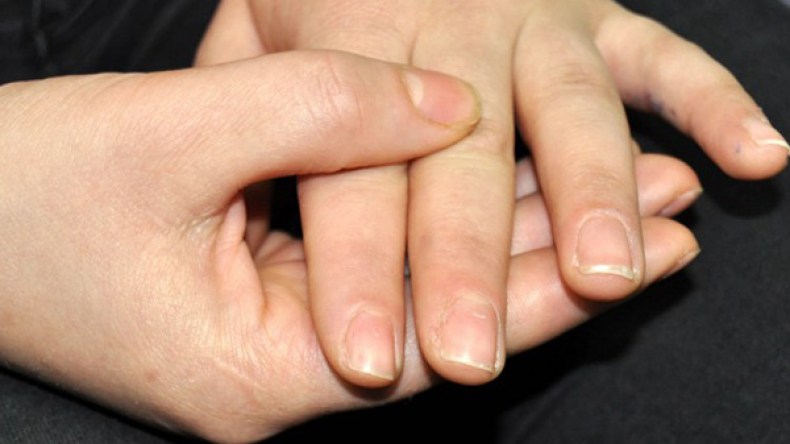 إمكانية تشخيص الأمراض من خلال لون الأظافر