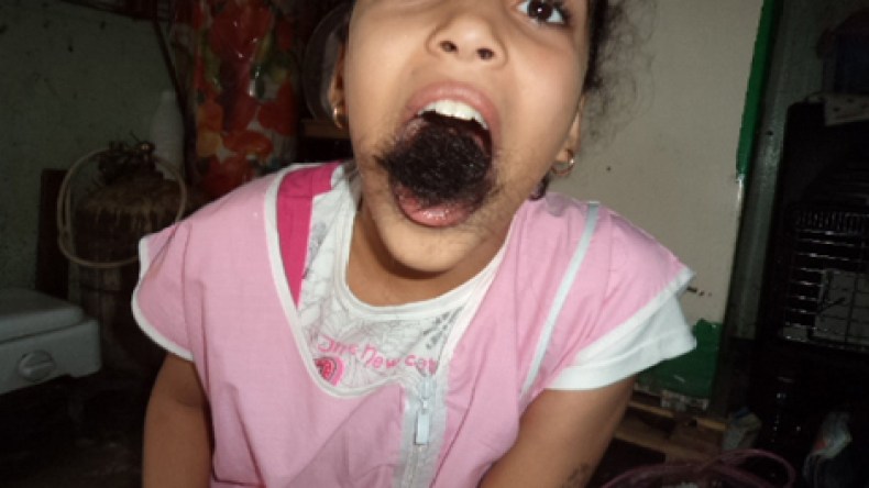 طفلة في الـ 10 من العمر تقذف من فمها أمتارا من الشعر