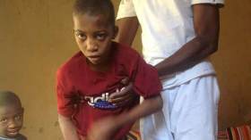 مرض غريب يصيب طفلين بتمنراست ويفقدهما الحركة كليا