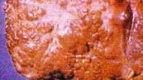 1.5 مليون جزائري مصاب بالتهاب الكبد الفيروسي