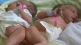 الملك السعودي يتكفل بعلاج توأم سيامي جزائري