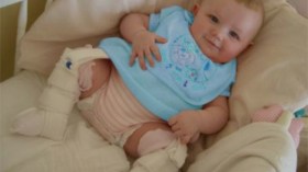 تجنبوا خلع الولادة عند الأطفال بالكشف المبكر