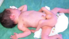 عائلة الطفلة ذات الأربعة أرجل تطالب تدخل المحسنين لعلاجها بالخارج