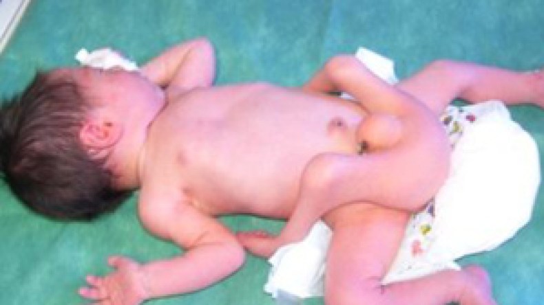 عائلة الطفلة ذات الأربعة أرجل تطالب تدخل المحسنين لعلاجها بالخارج