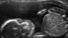 أم أرادت مشاهدة جنينها عبر “السونار” فوجدته “ملاكماً”