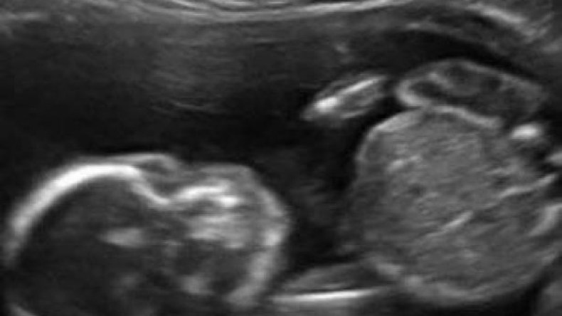 أم أرادت مشاهدة جنينها عبر “السونار” فوجدته “ملاكماً”
