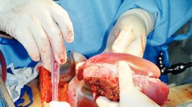 الجزائريون لا يزالون يرفضون التبرع بأعضائهم بعد وفاتهم…