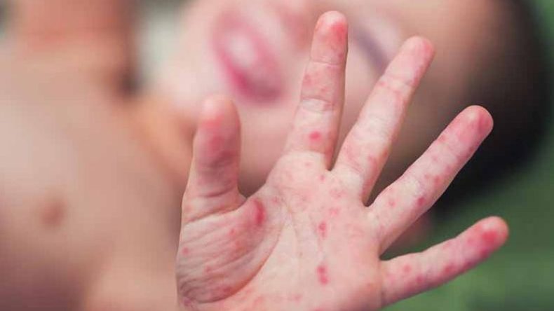 تعقد وضعية طفلين مصابين بـ”البوحمرون” في خنشلة