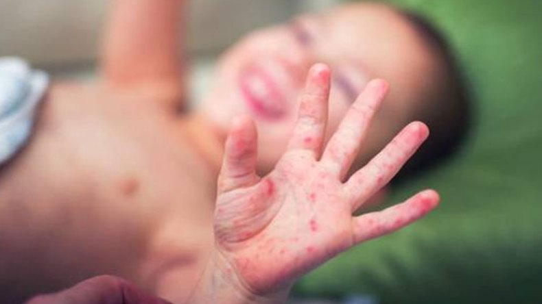 وفاة طفلة بمرض “البوحمرون” في باتنة