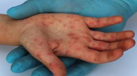 إصابة 24 تلميذا بداء الحصبة في الجلفة