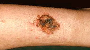 USA : nouvelles armes prometteuses contre le cancer agressif de la peau