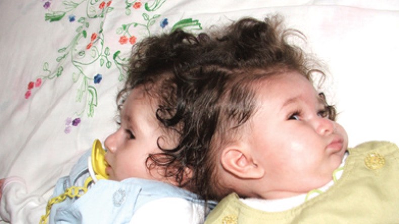 توأم سيامي يعانيان..ووزارة الصحة لا تحرك ساكنا لإنقاذهما