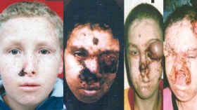 أربعة أبناء تتشوه وجوههم ويموتون في صمت بسوق أهراس