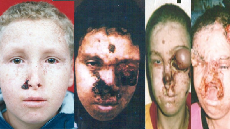 أربعة أبناء تتشوه وجوههم ويموتون في صمت بسوق أهراس