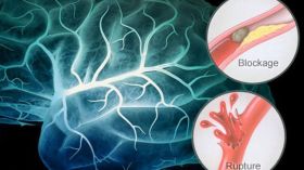 50 ألف إصابة جديدة بالجلطة الدماغية سنويا في الجزائر